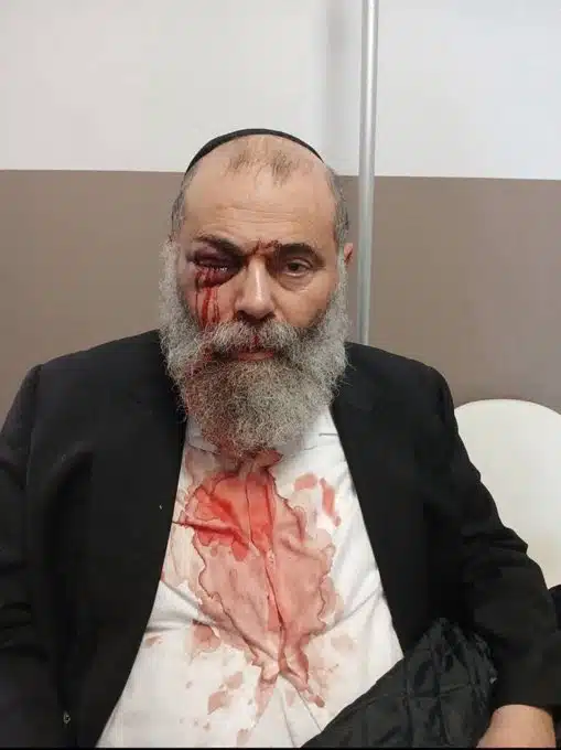 Injured Jewish man with a swollen, bloodied eye and blood-stained shirt after antisemitic attack in Yerres, France.