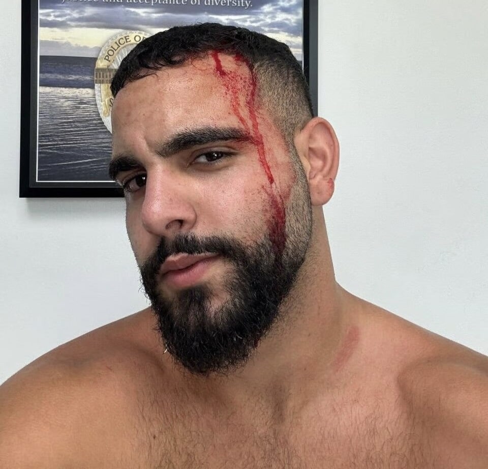 Israeli man with blood streaming down his face after being attacked by a pro-Palestinian mob at Santa Monica Pier.