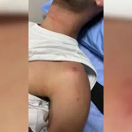 Injuries visible on the shoulder and neck of one of the Israeli victims following the reported assault in Koh Samui, Thailand.