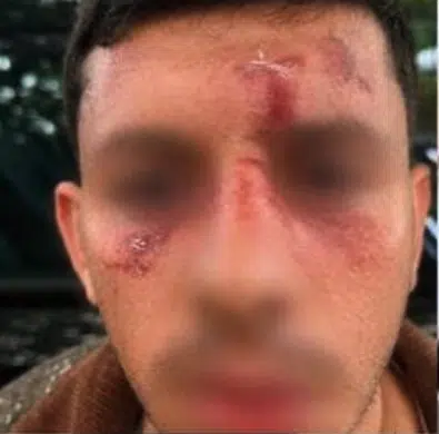 A young man with visible wounds across his forehead, nose, and cheeks following an antisemitic assault in Golders Green, London, on May 19, 2026.